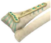 Dia-Meta Bone