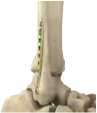 Fibula bone