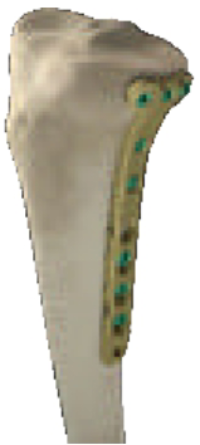Tibia bone visual