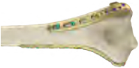 VA Distal Lateral Humeral on Bone
