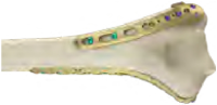 VA Distal Medial Humeral on Bone