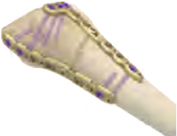 VA Distal Radius on Bone