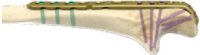 VA Olecranon Plate on Bone