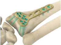 Volar Column Bone